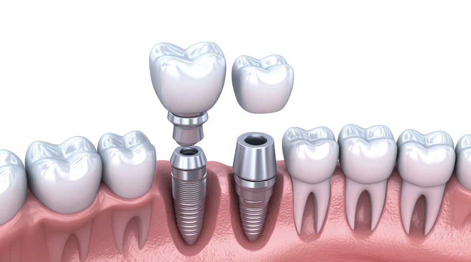 Ilustración de implante dental con corona sobre la encía