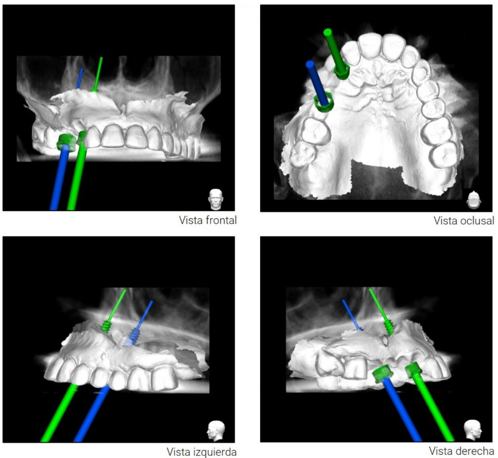 Vistas de la planificación 3D de implantes
