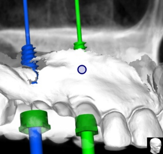 Planificación digital de implantes con guías quirúrgicas en 3D