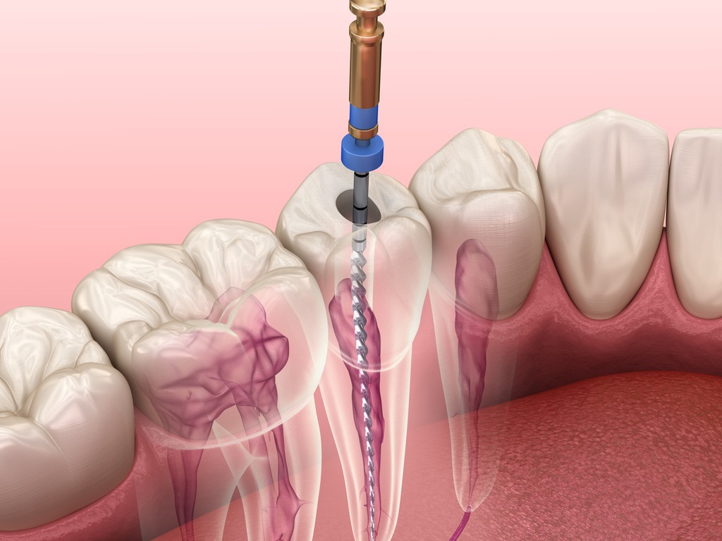 Clínica Dental García del Olmo, endodoncia