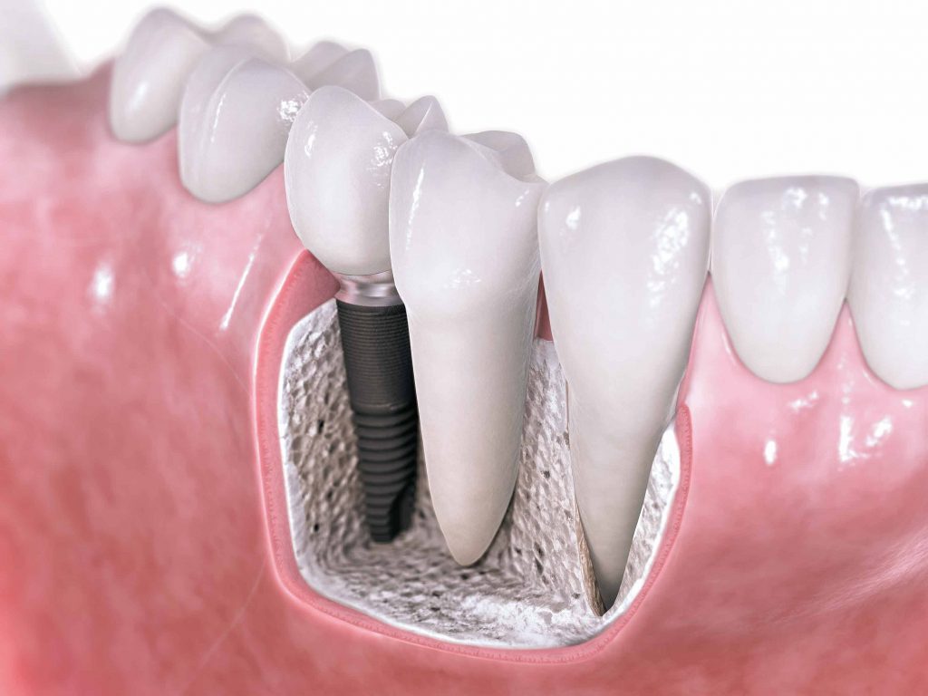 Clínica Dental García del Olmo, implantes dentales