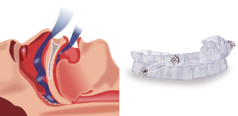 Tratamiento de la Apnea del Sueño en Dental García del Olmo