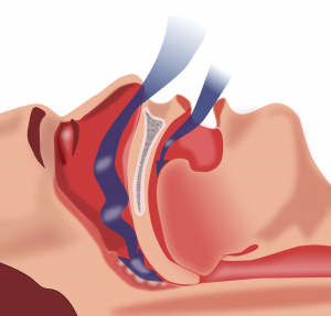 Tratamiento de la Apnea del Sueño en Dental García del Olmo