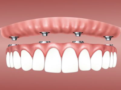 Prótesis Fija sobre Implantes - Clínica Dental García del Olmo